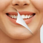 teeth whitening