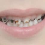 Cavities Not Just for Kids